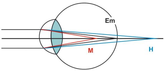 Рефракция в близоруком глазу и оптическая коррекция близорукости изображены
