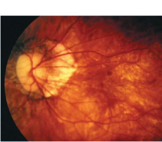 Рефракция в близоруком глазу и оптическая коррекция близорукости изображены