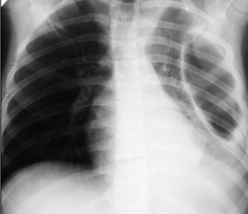 Рентгенологические синдромы поражения легких таблица thumbnail