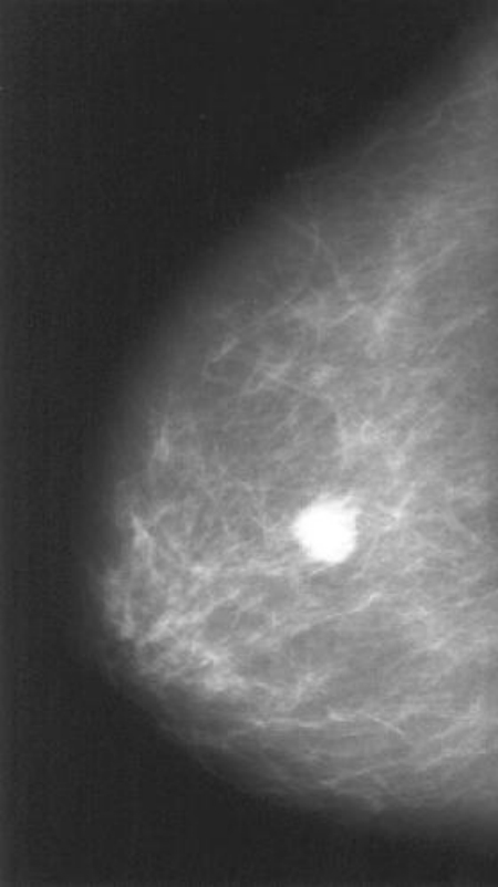 Что такое фиброаденоз молочной железы. Фиброаденома молочной железы маммография. Маммография фиброаденома. Киста и фиброаденома на маммографии. Обызвествленная киста молочной железы на маммографии.