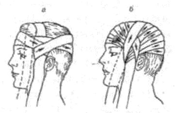 Ранение волосистой части головы повязка. Повязка чепец техника наложения. Восьмиобразная повязка на затылок и шею. Перевязка восьмерка на затылок. Повязка восьмерка на голову.