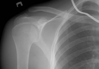 Разрыв акромиально-ключичного сочленения операция Разрыв акромиально-ключичного сочленения операция